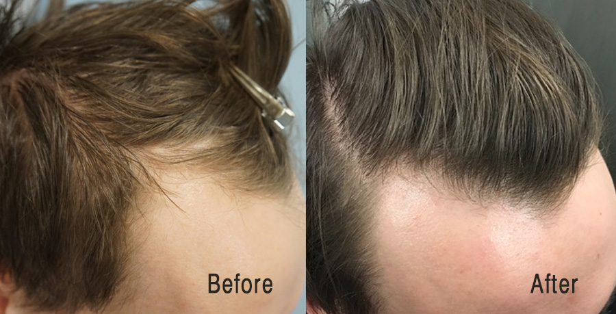 PRP-Hair-Loss-Results